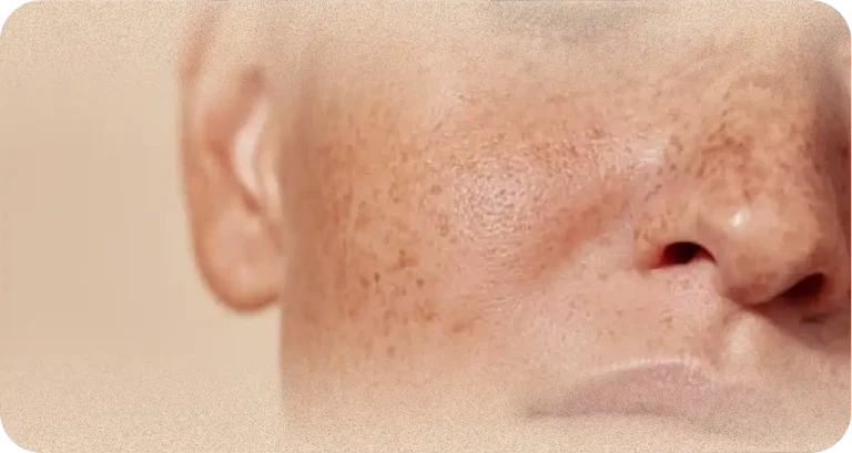peel2