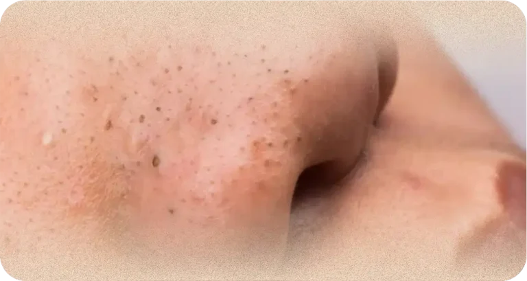 peel4
